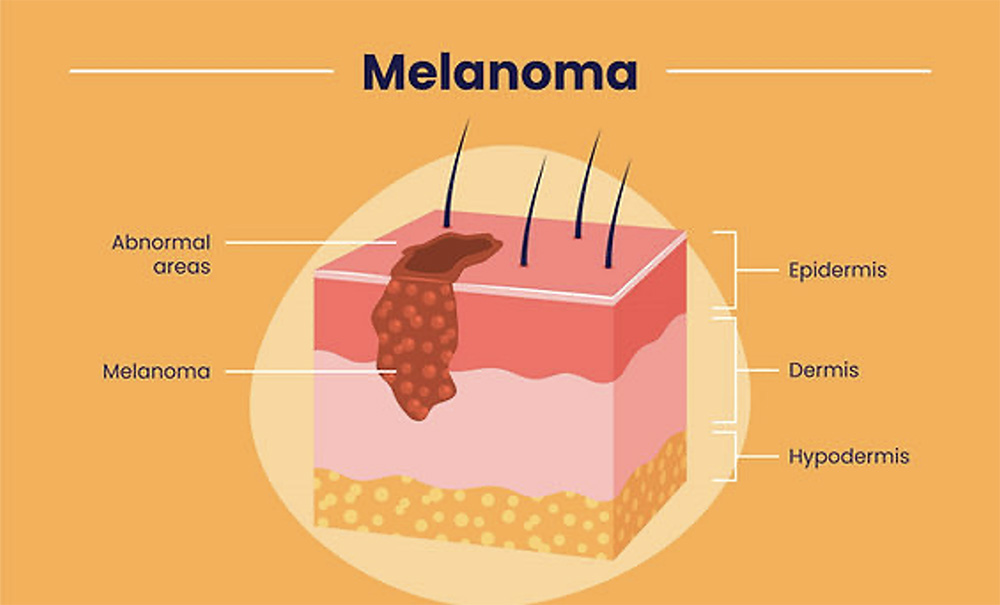 skin cancer melanoma in dermis layer