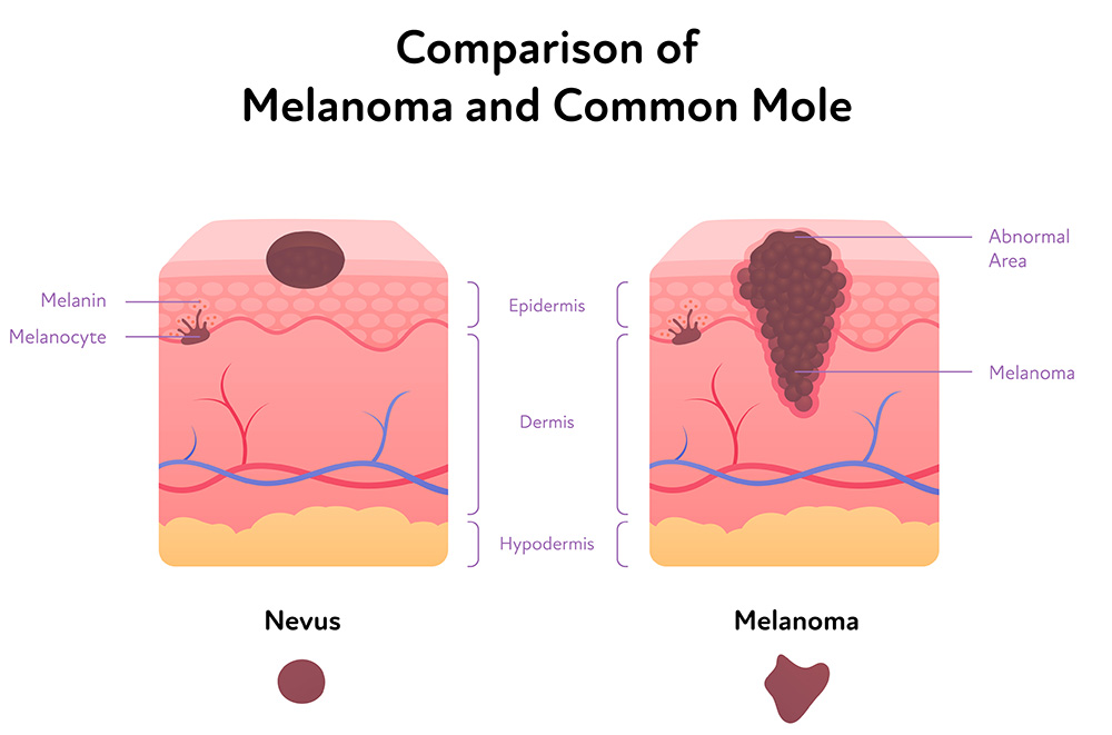 melanoma compared to a common mole