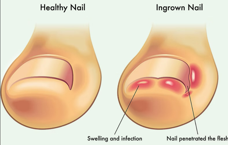 dr atish chudasama ingrown toenail specialist